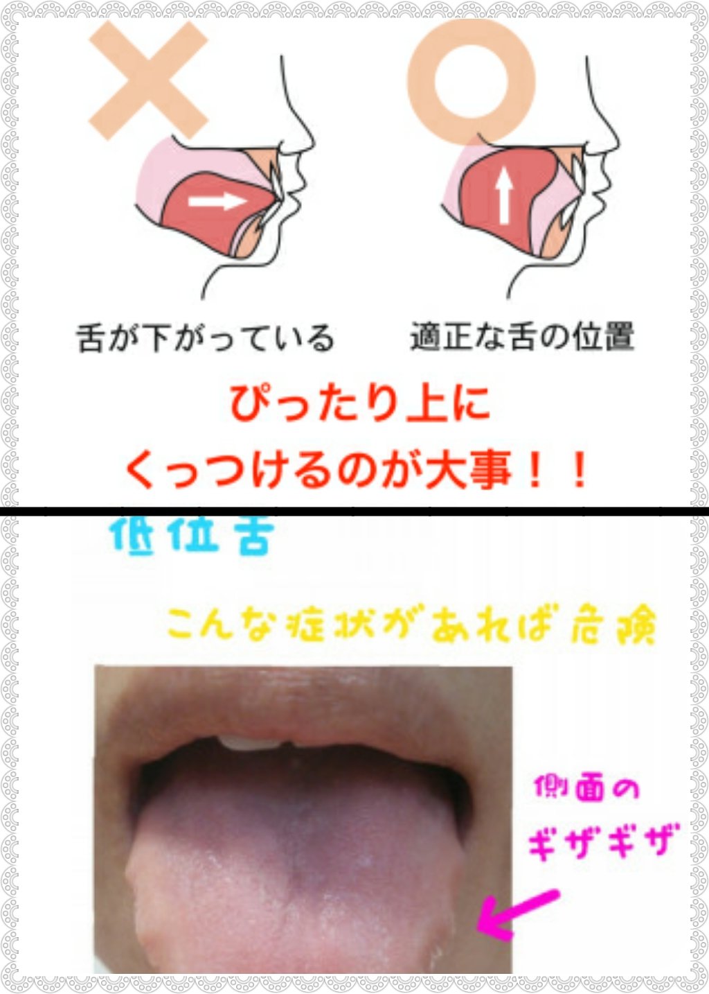 Aco בטוויטר 舌の位置を正しい場所にして舌回し4ヶ月毎日続けていた効果なのか顎の形が変わって細くなった 舌の位置が正しくないと顔が大きくなったり二重顎になる 舌回しすると輪郭もシュッとするよね ダイエット垢さんと繋がりたい 美容垢さんと繋がり