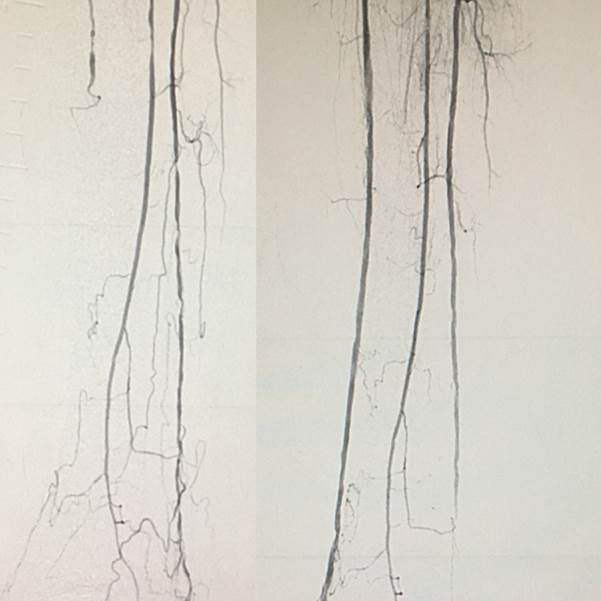 bsc_vascular's tweet image. Starting Monday with an awesome #Rotablator case by Dr. Paul Michael #drsavealimb #freeflowing