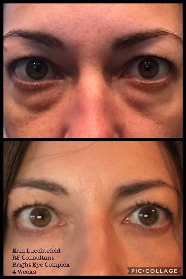 RPeichlMcGee's tweet image. Are you having a rough Monday? I hear ya... I couldn’t sleep last night 😞 Check out my friend, Erin’s results from our newest product.... Erin, you’re always beautiful, but WOW, your eyes are POPPING! #brighteyecomplex #multifunctioneyecream