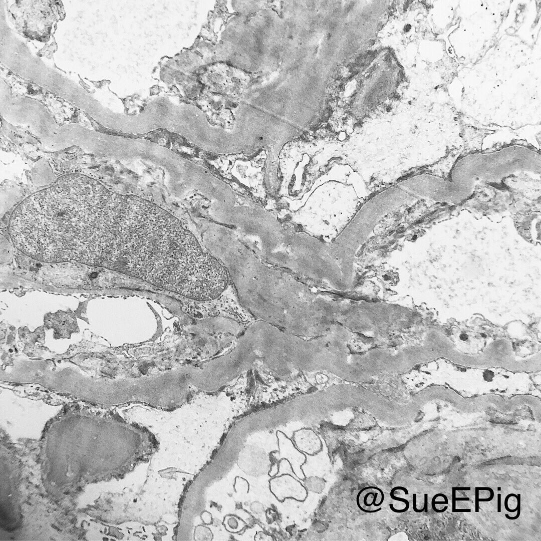 SueEPig's tweet photo. Nodular glomerulosclerosis also called Kimmelstiel-Wilson disease; nodules have a laminated appearance more evident with silver stain; diffuse thickening of basement membranes on EM ✨Specific for diabetes and MPGN, light chain disease and amyloidosis #learningkidney #renalpath https://t.co/0ryImiYbIY
