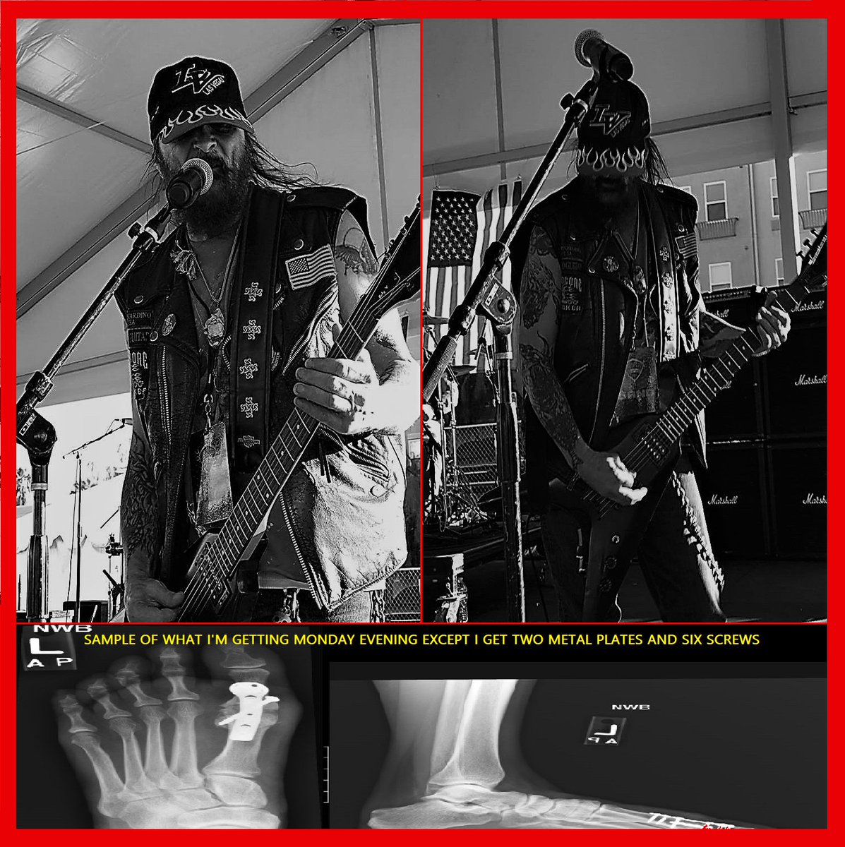 JCBERDOO's tweet photo. JC Berdoo Guitarist surgery Monday tonight January 29th Las Vegas NV except i get 2 metal plates and 6 screws then in 4 weeks back to rocking on tour Ouch #berdoo #jcberdoo #jediguitarist #madeinusametal #americanscars #armyofbikers #NAMM2018 #maga #foxnews #sanbernardino #USA https://t.co/F5oIgl1VZb