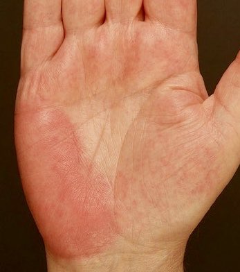 Prof Alex Navarini On Twitter Attentive Dermatologists Always Look For Little Disease Clues That Together Can Result In A Clinical Pattern I E Palmar Erythema If Present Think About Liver Thyroid Disease Rheumatoid