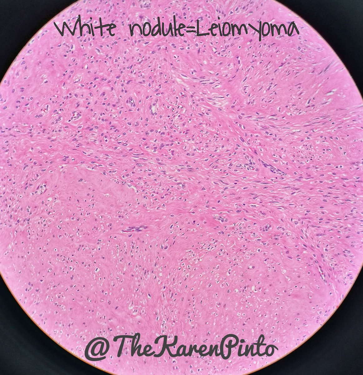 TheKarenPinto's tweet photo. Stuff within a uterus.. The comparison of the two of them next to each other, helps tell them apart!

#pathology #GYNpath https://t.co/HGsxAohlfz