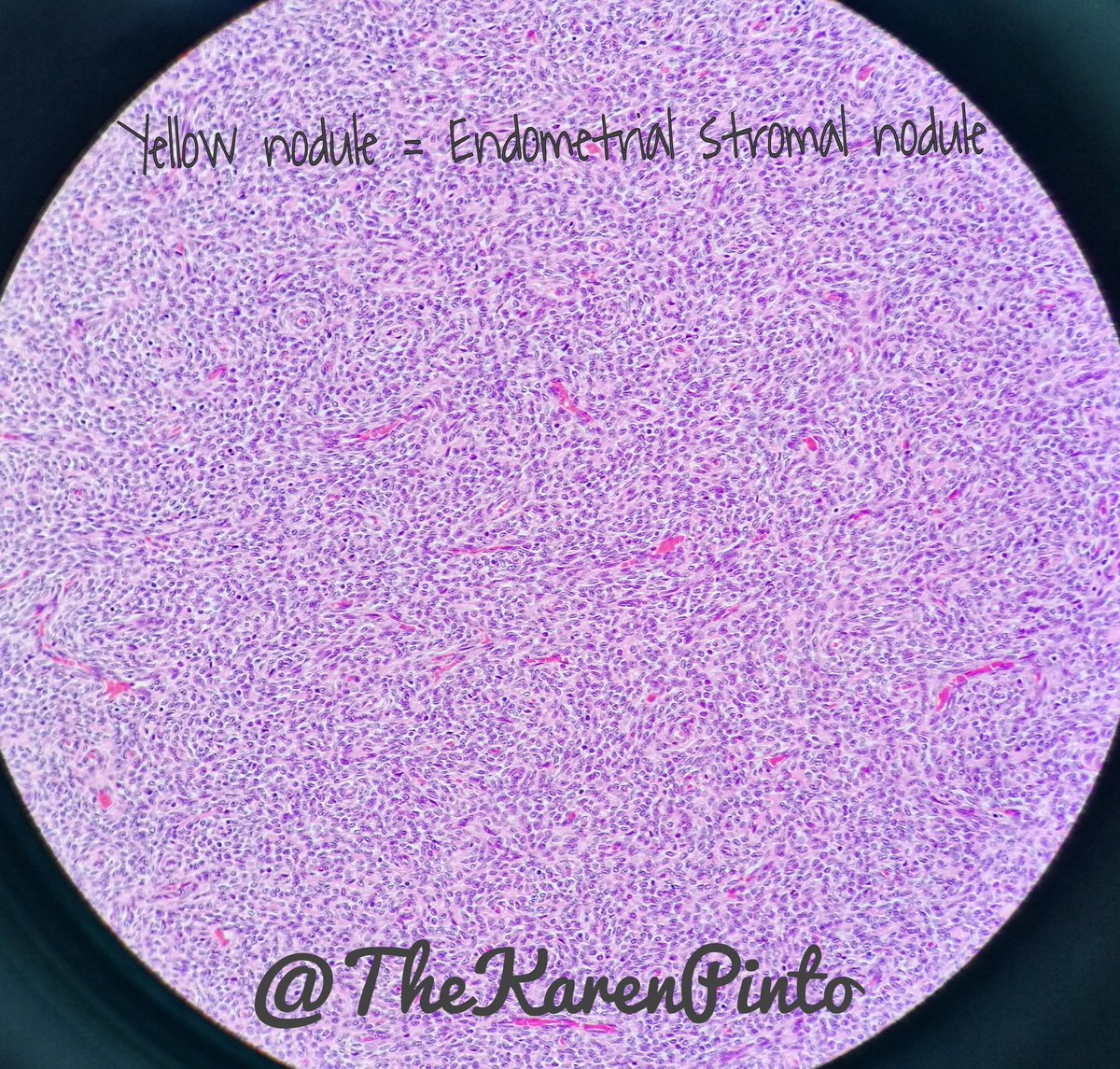 TheKarenPinto's tweet photo. Stuff within a uterus.. The comparison of the two of them next to each other, helps tell them apart!

#pathology #GYNpath https://t.co/HGsxAohlfz