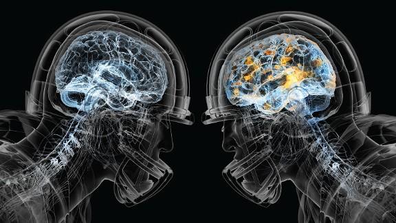 NeuroSplit1's tweet photo. DAY OF CHRONIC TRAUMATIC ENCEPHALOPATHY
What links science and sport? Whose side would you be on if these two disciplines entered a conflict?
If you want to know more about this visit our page: https://t.co/FVzrWPA2ok
Or our Facebook page: https://t.co/poxDekrTm0
#neurosplit https://t.co/aNV3vW6llD