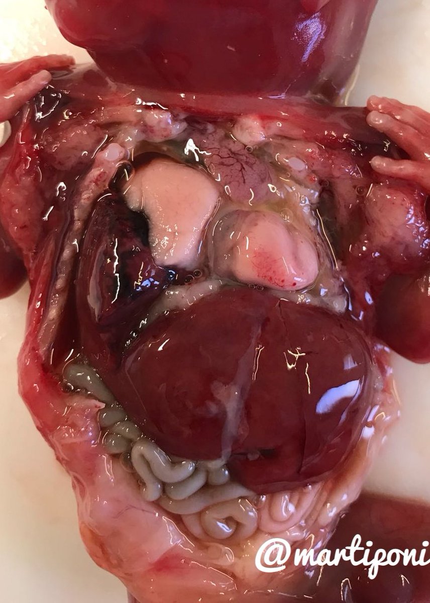 martiponi's tweet photo. Right diaphragmatic hernia in a fetus #pedipath #autopsy https://t.co/5Arjuubplc