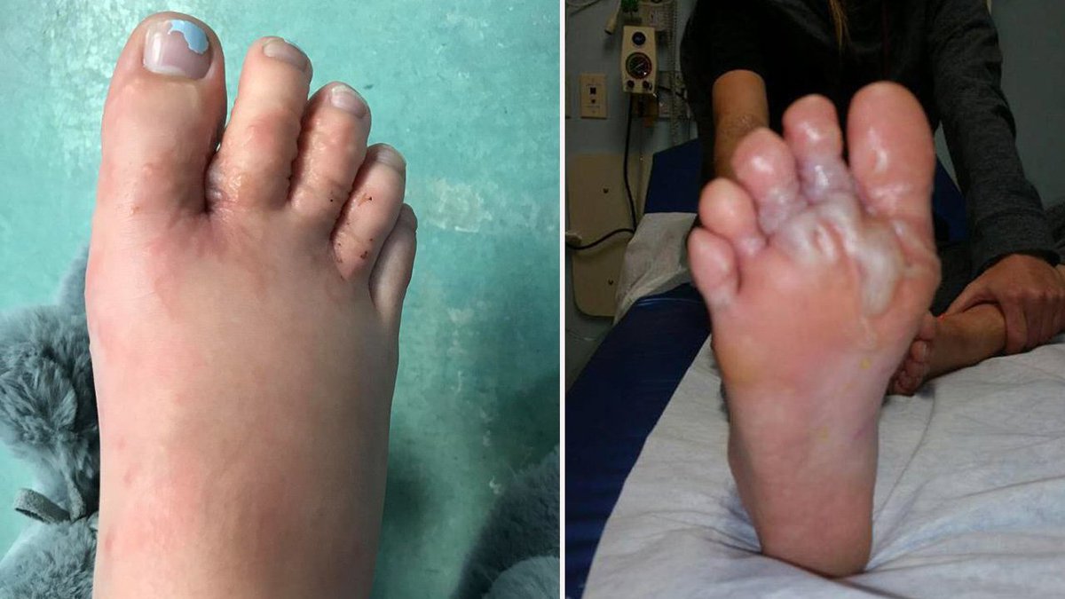 Couple warns others of dangers of walking barefoot on beach after they contracted hookworms. bit.ly/2nlKsJs?utm_so… https://t.co/7DKn3M9Isl