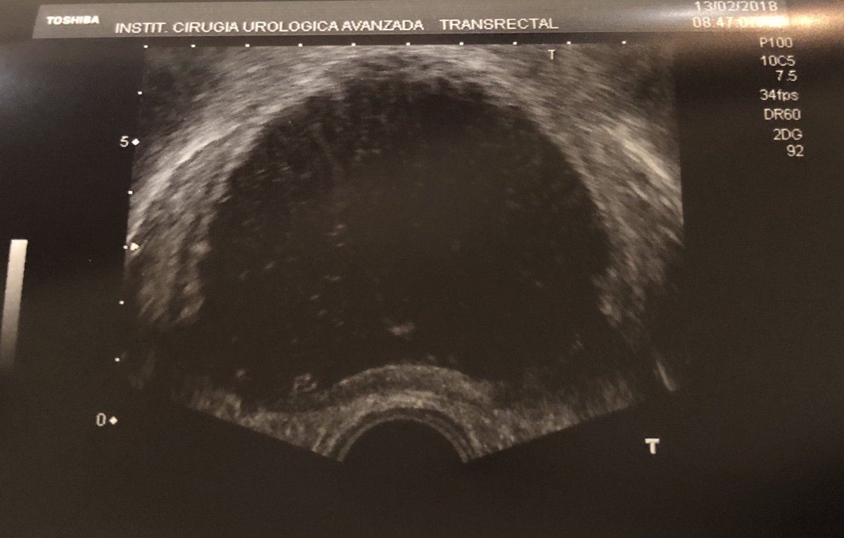 fgomsan's tweet photo. TRUS intraoperative control after en-bloc HoLEP on a 300+ cc prostate yesterday, 1.30 hour surgery thanks to the Piranha morcellator, hopefully the patient will go home today #EEProcks https://t.co/FYMJ2Xoc5J