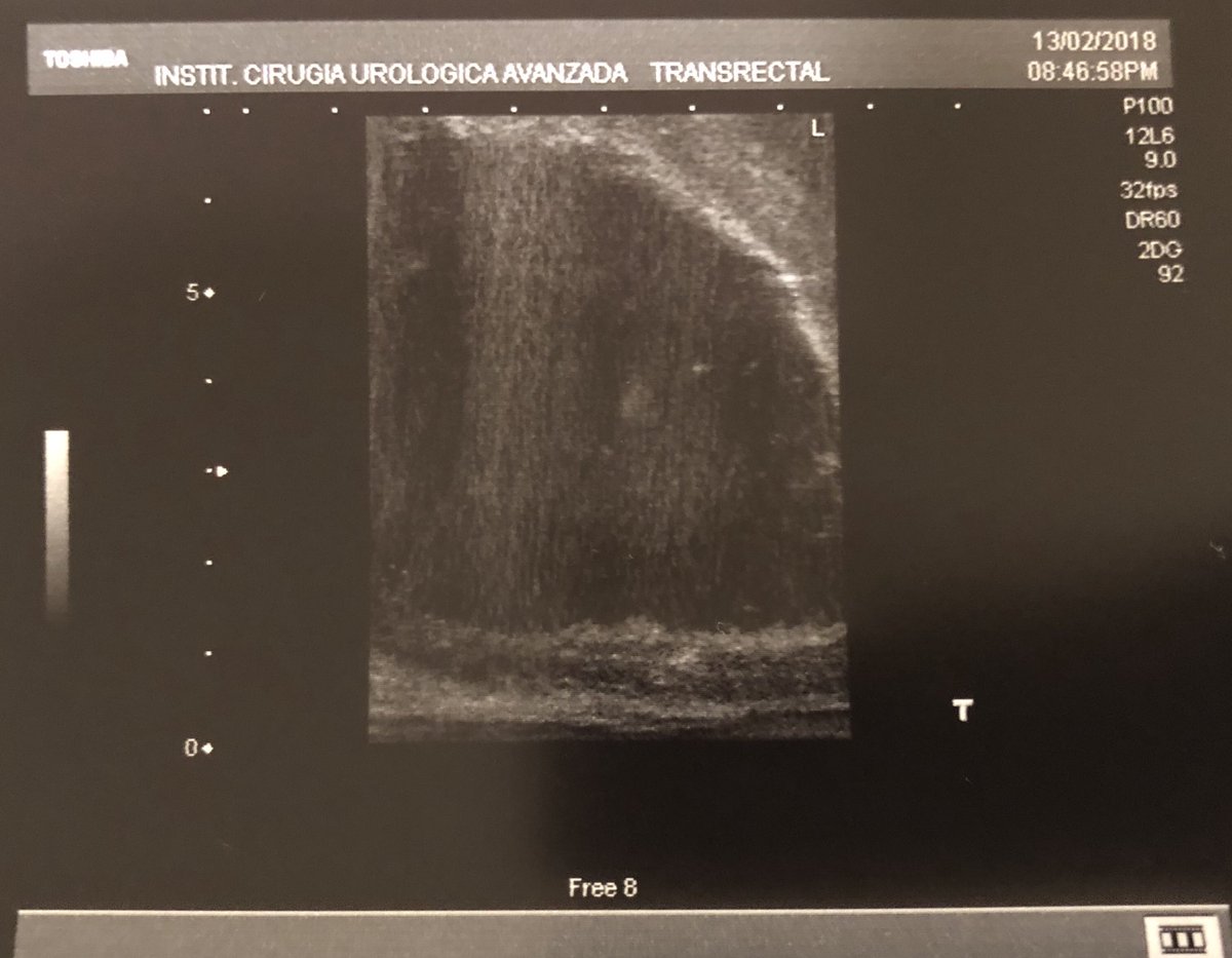 fgomsan's tweet photo. TRUS intraoperative control after en-bloc HoLEP on a 300+ cc prostate yesterday, 1.30 hour surgery thanks to the Piranha morcellator, hopefully the patient will go home today #EEProcks https://t.co/FYMJ2Xoc5J