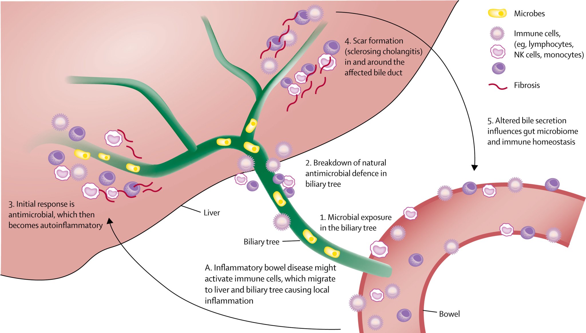 The Lancet Gastroenterology & Hepatology on Twitter "New TheLancet