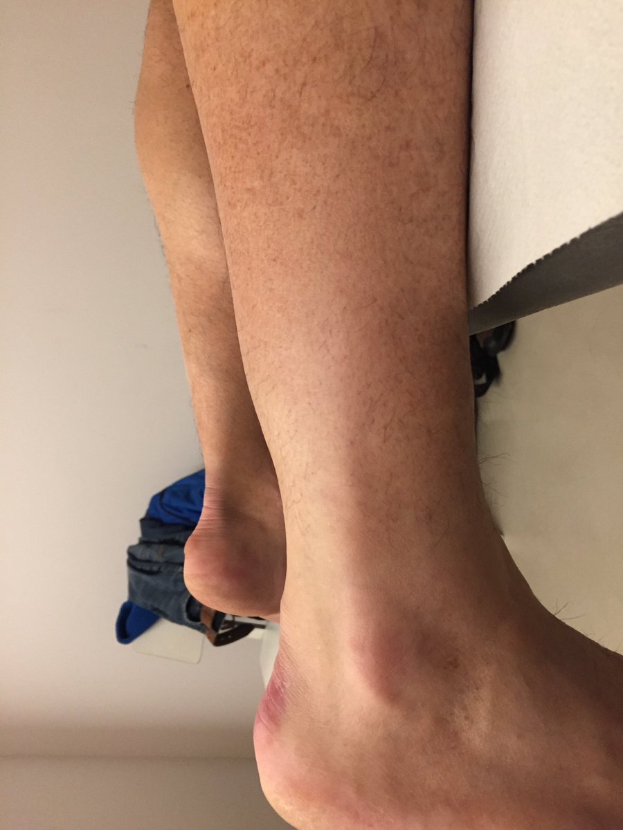 Treatment of calcane bursitis: what should you always remember Treatment of calcane bursitis: what should you always remember