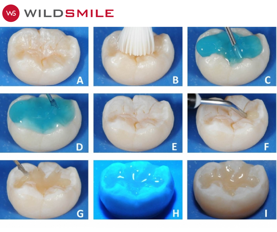 WILDSMILE_ES's tweet photo. Los selladores de fosas y fisuras son una barrera protectora aplicada en los dientes de los niños para impedir el desarrollo de las cáries. Los selladores combinados con una buena rutina de higiene dental ayudan a mantener la salud de la boca de los más pequeños. https://t.co/ADZXAky5et