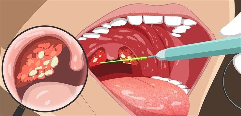 GoalDental's tweet photo. 👨🏻‍⚕️ ¿Bolitas blancas en la garganta? Es el #caseum que provoca tu mal aliento https://t.co/kPNIMjn8xO vía @infosalus_com #dentista #argandadelrey #carabanchel https://t.co/9L3NkpRJUO