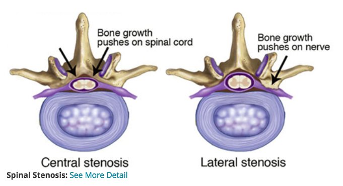 WallaceNilanPT's tweet photo. #TheMoreYouKnow:  What is #SpinalStenosis?  #WNPT #APTA

https://t.co/HSsJclFta3 https://t.co/Z2mjqVQBks