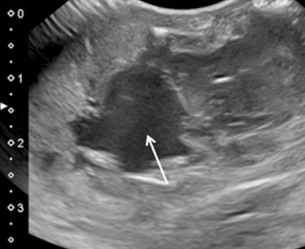 Online now:
Presence of venous lakes on #ultrasound in rapidly involuting congenital #hemangiomas (RICH) may predict cardiac failure
ow.ly/ydcS30i3Fig
#PedsRad