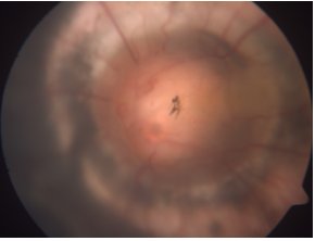 OphthaTweets's tweet photo. Optic disk contractility in morning glory disk anomaly via #JAAPOS https://t.co/j09Z1aKNOC https://t.co/AK8SN4Kxzh
