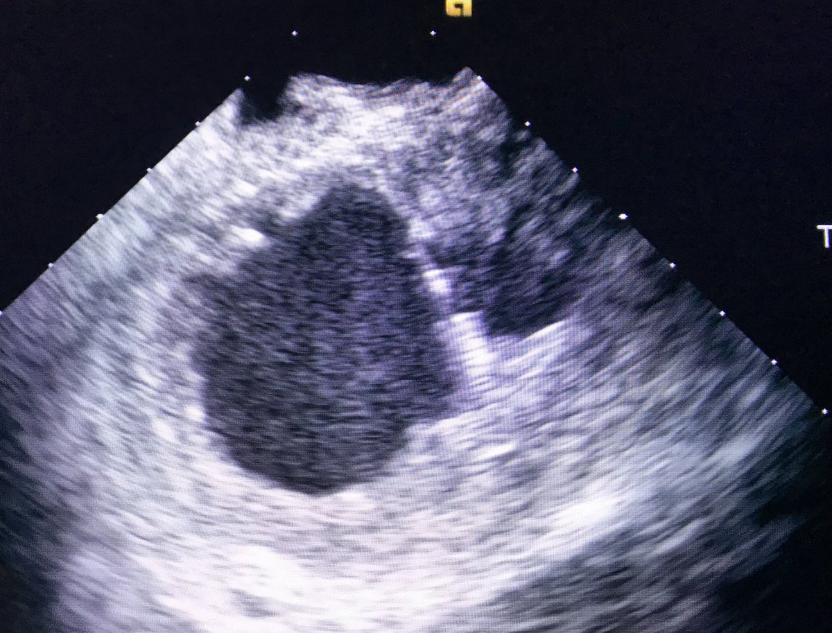 Dr_Santangeli's tweet image. First-in-man interventricular septal access from a femoral approach in double mechanical valve for #VTach ablation with @DrFerminGarcia @PennMedNews @Penn