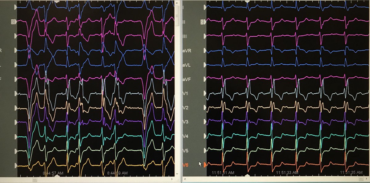 Dr_Santangeli's tweet image. First-in-man interventricular septal access from a femoral approach in double mechanical valve for #VTach ablation with @DrFerminGarcia @PennMedNews @Penn