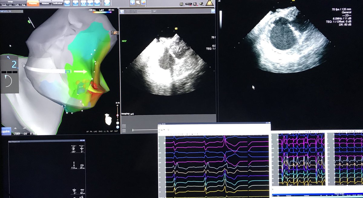 Dr_Santangeli's tweet image. First-in-man interventricular septal access from a femoral approach in double mechanical valve for #VTach ablation with @DrFerminGarcia @PennMedNews @Penn