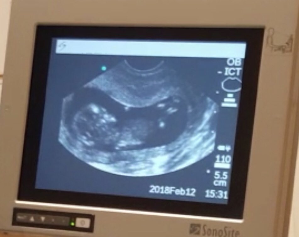 GRACELLCCA's tweet photo. Baby is doing great! Thank you to our surrogate M. for making it possible! 💜 
https://t.co/lzmVRZTlR8
#surrogacy #surrogacyagency #baby #growing #strong #healthy #surrogatemother #bringingjoy #giftoflife #happiness #futureparents #mom #dad #parenthood #love #joy #family https://t.co/Ixa7XK72JC