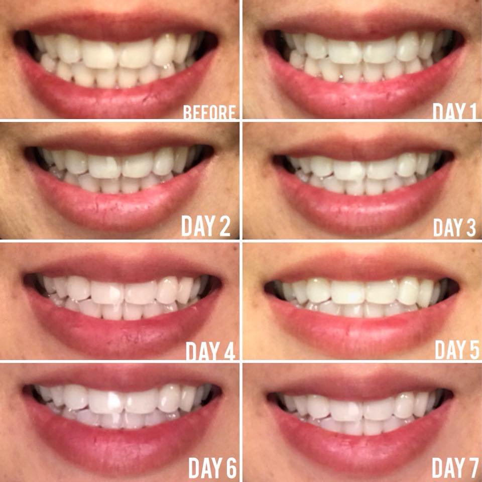 burst whitening strips