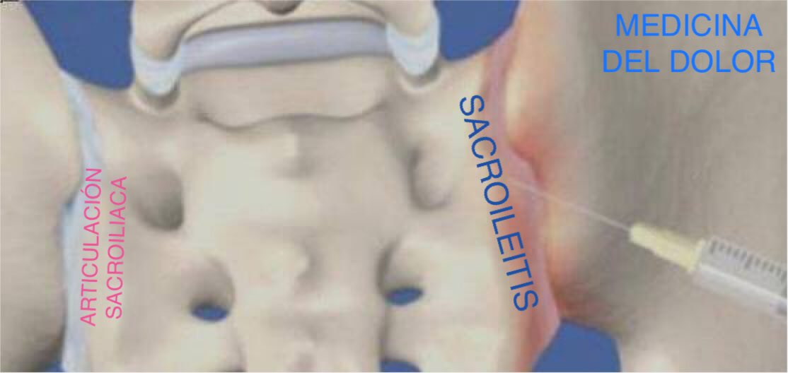 Meddeldolor's tweet photo. El dolor de la articulación sacroiliaca, se refleja como dolor lumbar bajo un 75%, dolor en la zona glútea un 94% y dolor irradiado a piernas un 28%.
Contamos con tratamientos intervencionistas para el control del dolor originado por sacroileitis https://t.co/v5mK0O4aJB