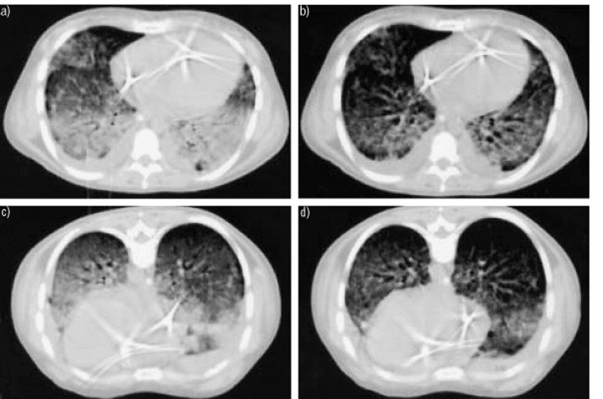 yourICM's tweet photo. Prevalence of #prone position use and complications among ventilated #ARDS patients. correspondence - the #APRONET trial! Free link: https://t.co/Pon7yc00Cr https://t.co/Rmi3Kt6ip8