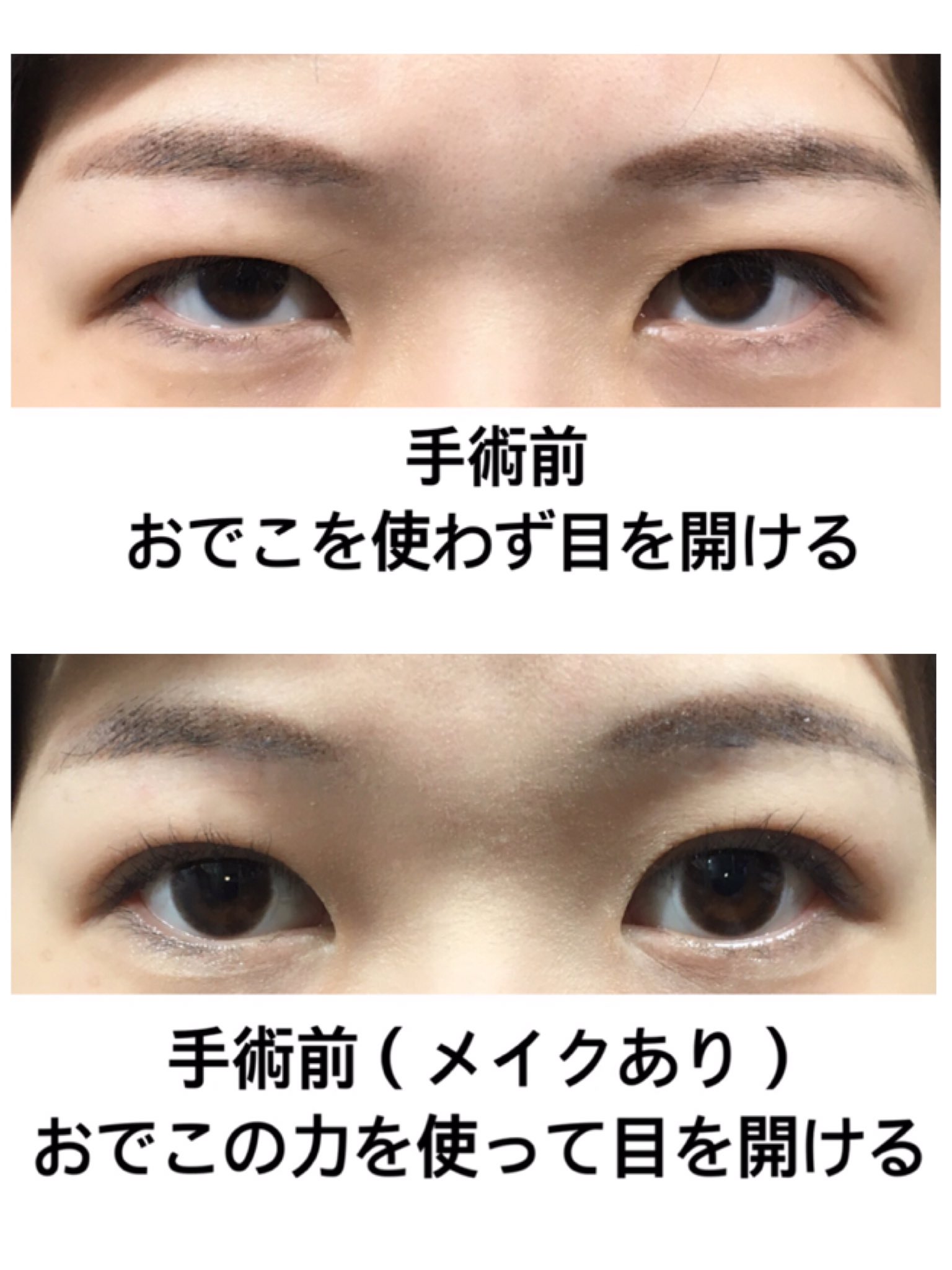 たいやき 眼瞼下垂 保険適応 Dt Xx お辛い症状があるようですね わたしは先生でないので 決定的な判断はしかねますが 眼瞼下垂のセルフチェックなどをされて 当てはまれば保険適応手術を受けられると思います ただ 先生によっては40代以降しか