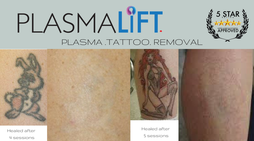 plasmaliftca's tweet photo. Check out our Plasmalift Tattoo Removal. For more details, call us at 1.866.330.9490. Check our website at https://t.co/pbxDTRvlpY and don't forget to follow us here on Twitter. https://t.co/0mQqU4fnYK