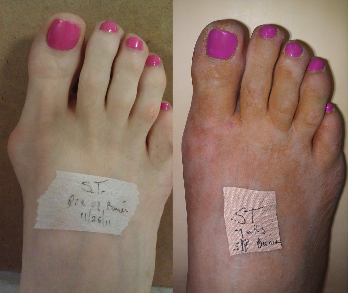 ParkPlazaFoot's tweet photo. NO MORE PAINFUL BUNIONS- 7 week Post Operation. Can you see a scar? Dr. Sherman Nagler preforms a unique incision for Bunion Surgery to limit scaring.
Be yourself again with NO PAIN. Don't wait, Call us today. #Houstonsfootdoc #Houstonpodiatrist #FootHouston #ShermanNagler https://t.co/5yPEchw2bm
