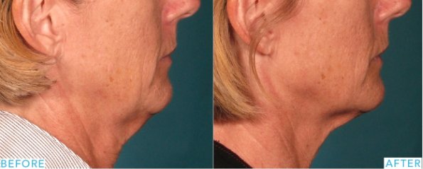 Dr. Chwalek, Dr. Gmyrek, and Dr. MacGregor have extensive clinical experience with Ultherapy. Ultherapy uses micro-focused ultrasound to tighten and lift skin, resulting in higher eyebrows, smoother neck, and tighter jawline, chest, abdomen, arms, and knees.