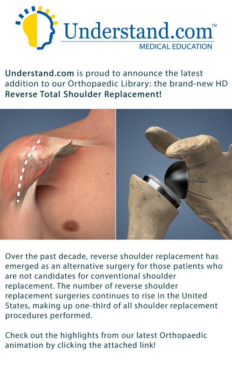 understandmed's tweet photo. https://t.co/b4SN52ZyRP is proud to announce the latest addition to our Orthopaedic Library: the brand-new HD Reverse Total Shoulder Replacement! Check it out here: https://t.co/bbVVV1VOjM https://t.co/iVaWYvEzpY