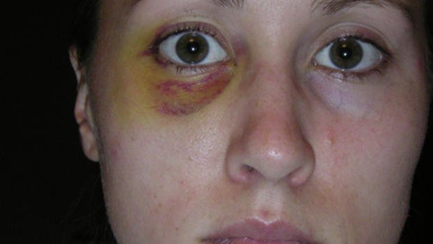 dumbassgenius's tweet image. 80% certain that our creepy President has spanked it to #RobPorter&apos;s ex-wife&apos;s black eye photo.
