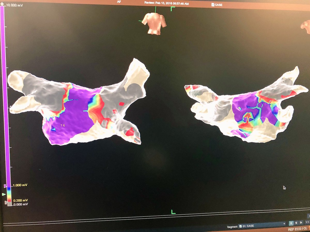 First case of Tactisense in Florida: zero fluoro: SE field scaling improves overall map compared to impedance only map : Definitely enhanced and much improved version of a Tacticath:
“Mercedes has an AMG engine”