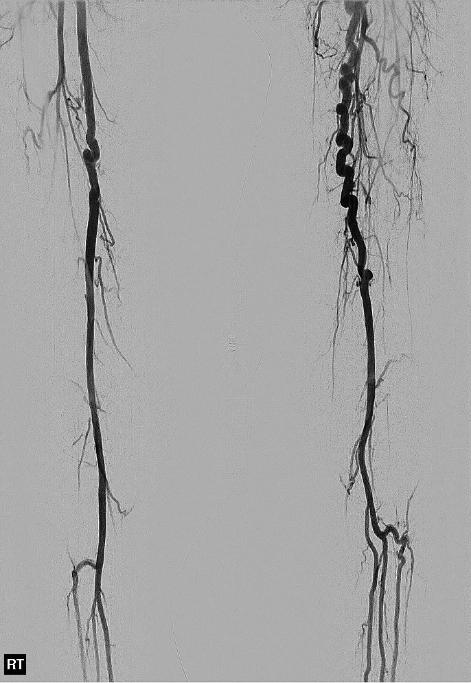 Emergent #IRad #embolization of a ruptured splenic artery aneurysm in Menkes disease with a mind-bending run-off. #PedsIR never disappoints @socpedsir #twittIR #withoutascalpel