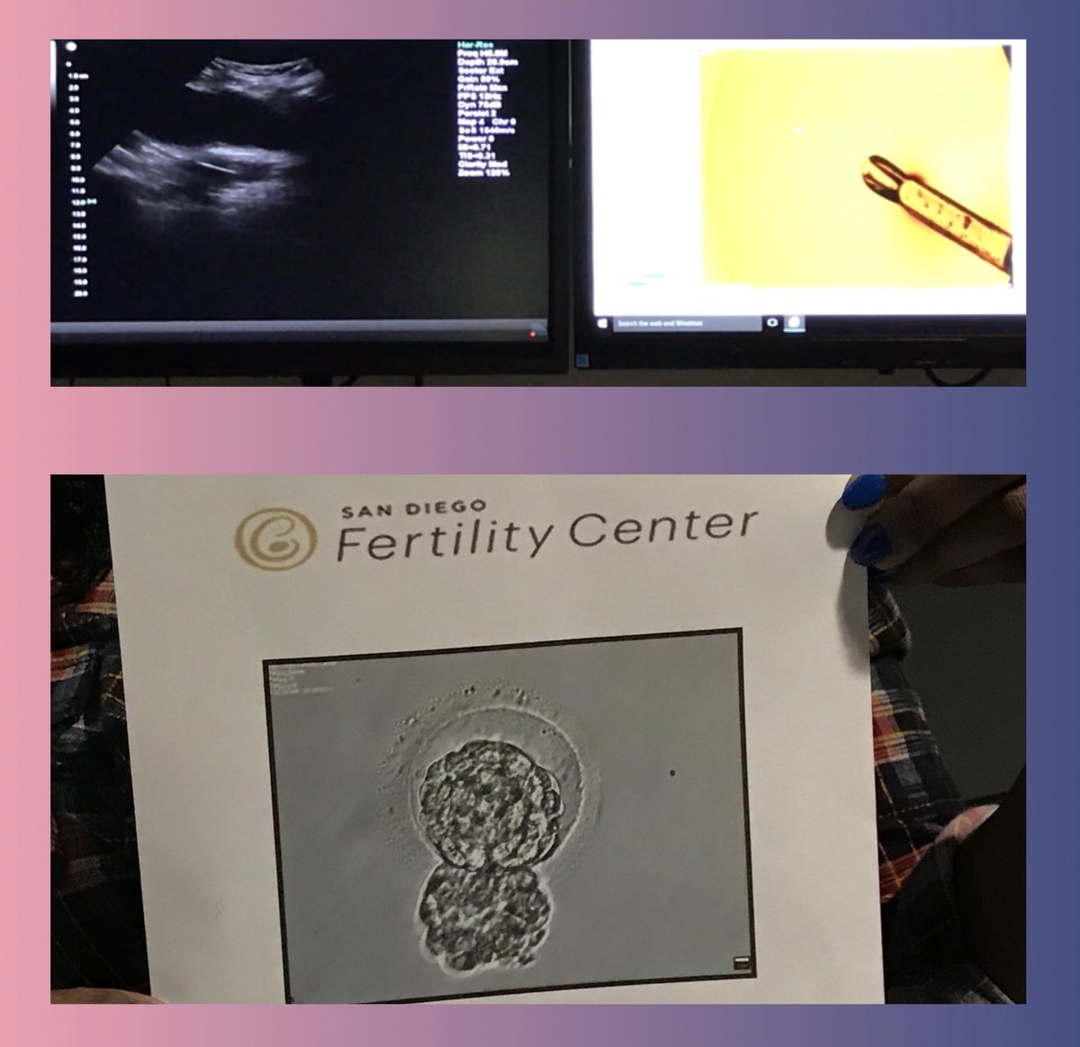 GRACELLCCA's tweet photo. Another successful embryo transfer today. Fingers crossed for positive results in 10 days!🤞🤞👶 

https://t.co/lzmVRZTlR8 https://t.co/VFPl4JhrVo
