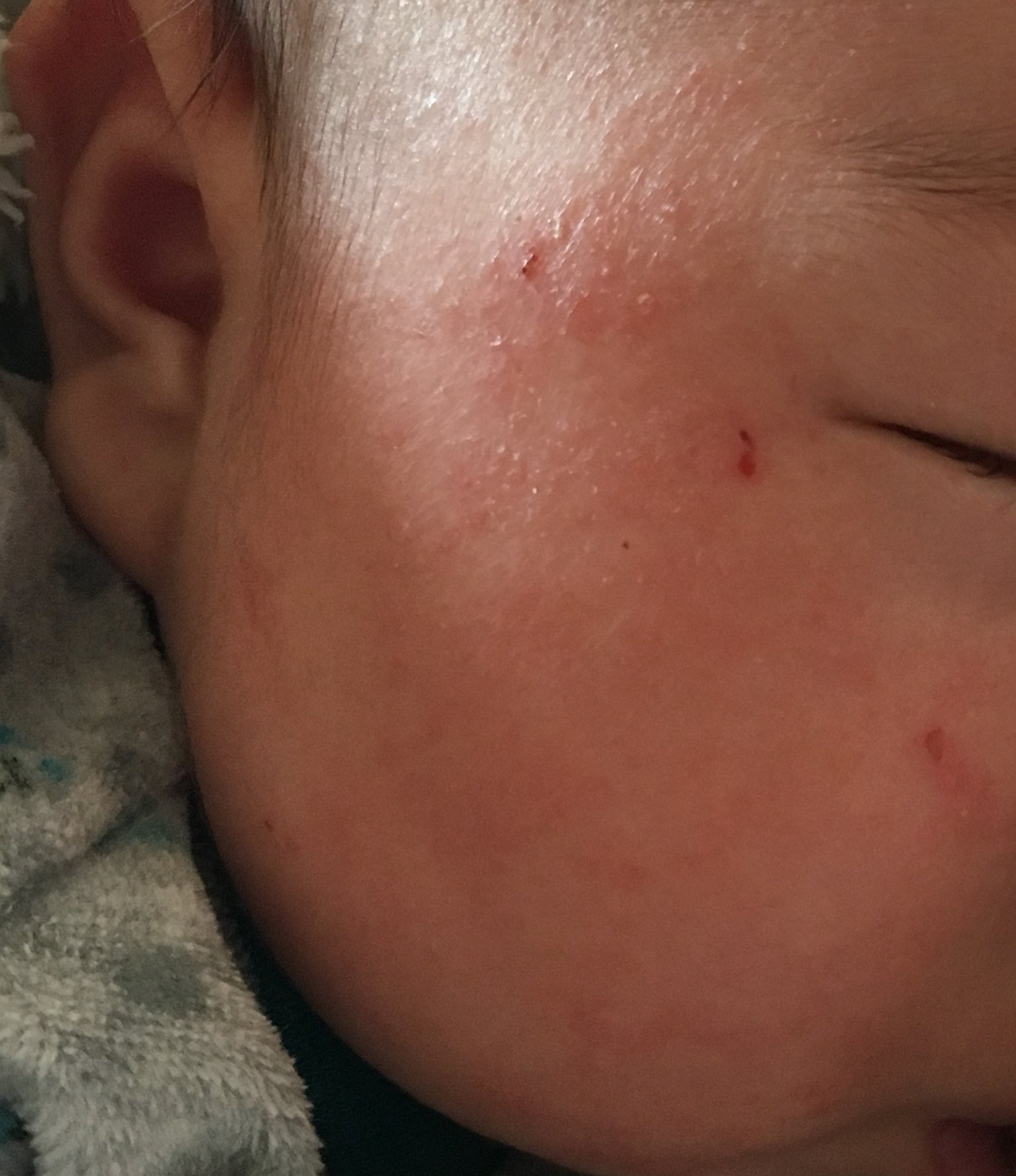 ぐうたらこ A Twitter 乳児湿疹 ステロイドで炎症抑えて頻回保湿したらだいぶキメが出てきた 母乳やヨダレだけじゃなく涙でもかぶれる T Co Zrze2gwjhs Twitter