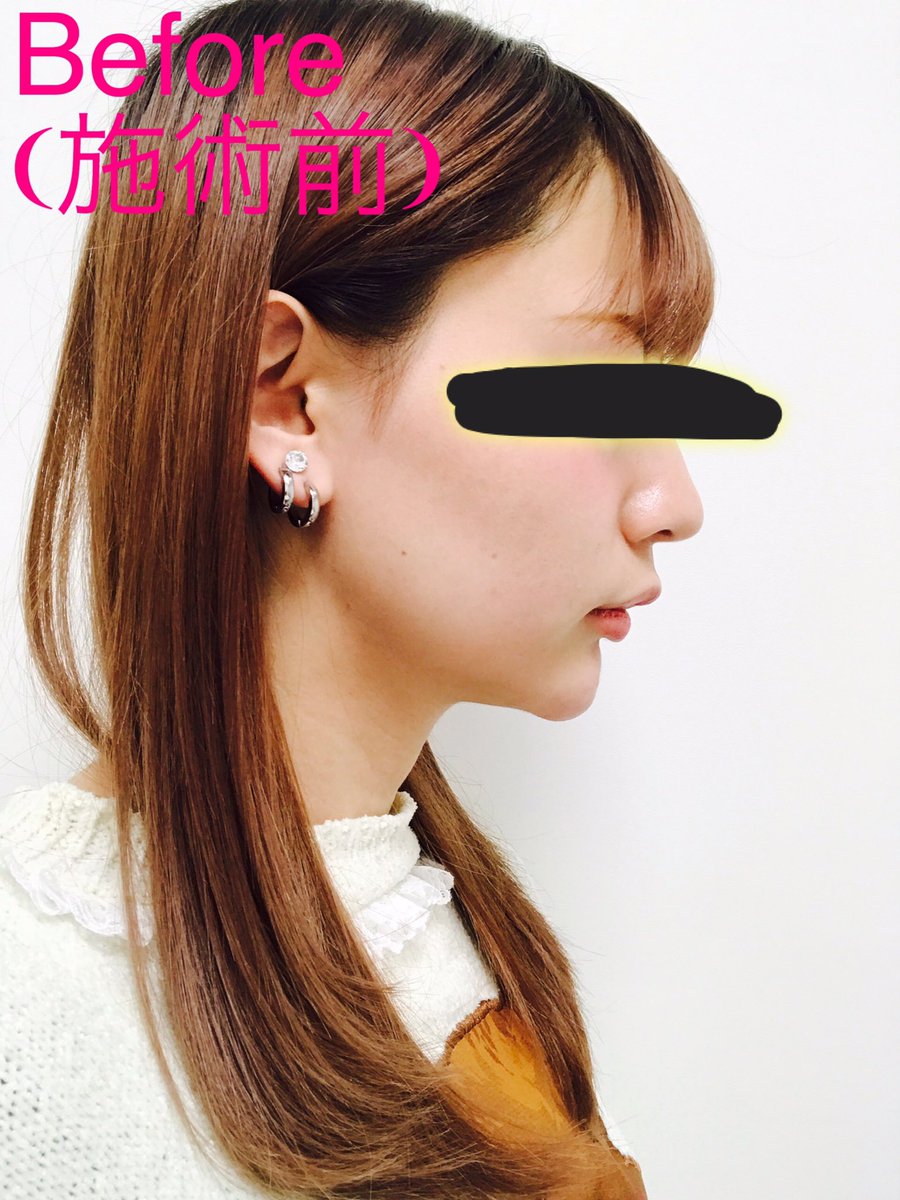 真野ゆりあ Na Twitteri 銀座taクリニックさんでtac式ツヤ肌コラーゲンリフトしてきました 写真だと少し伝わりずらいけど 術後からかなり輪郭変わった ここから徐々に細くなって 1ヶ月後にはもっと顔小さく なってるみたいだから楽しみ 銀座taクリニック