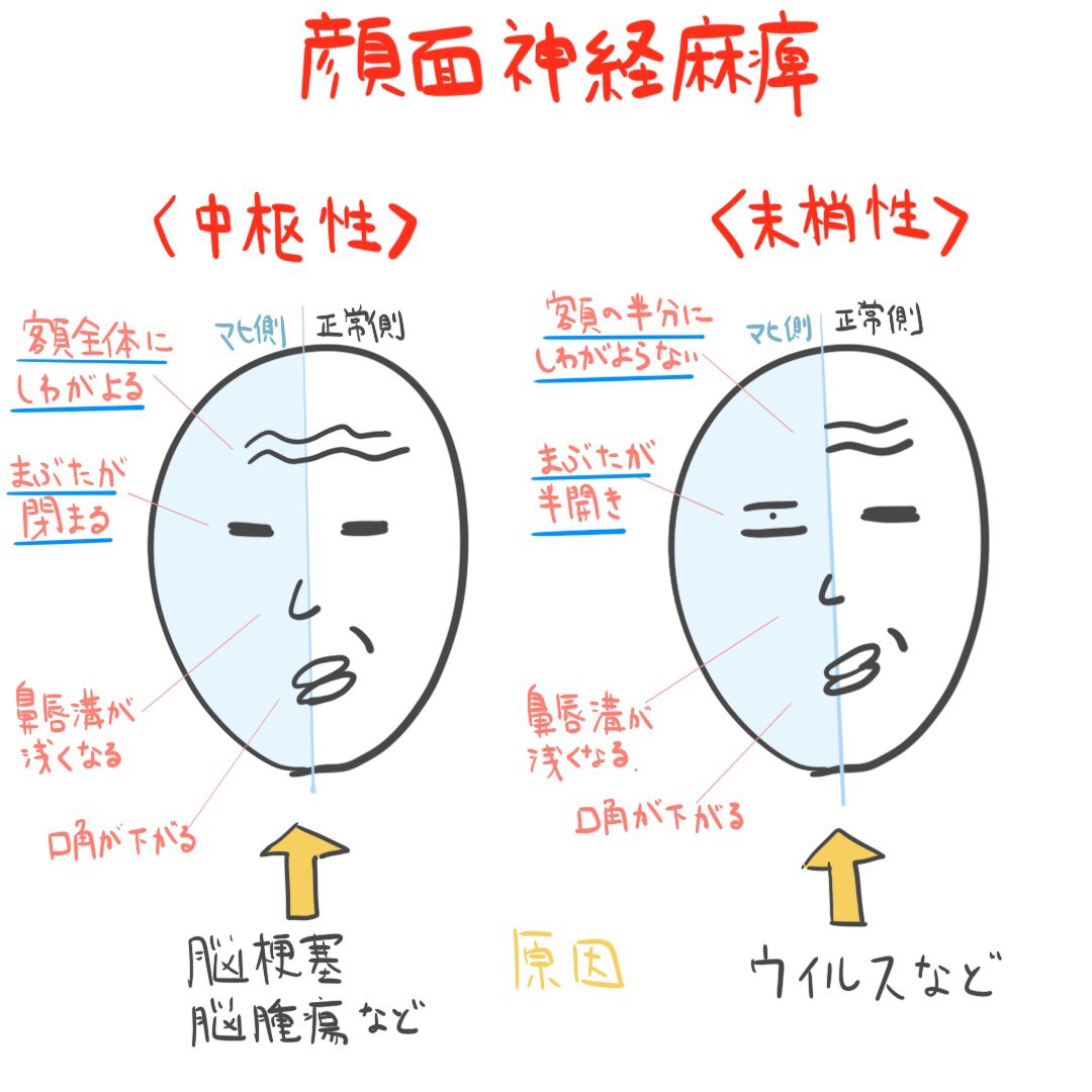 ゴロ 解剖生理イラスト En Twitter パッと見で分かる 顔面神経麻痺 中枢性麻痺と末梢性麻痺の違い ゴロ 解剖生理イラスト En Twitter パッと見で分かる 顔面神経麻痺 中枢性麻痺と末梢性麻痺の違い