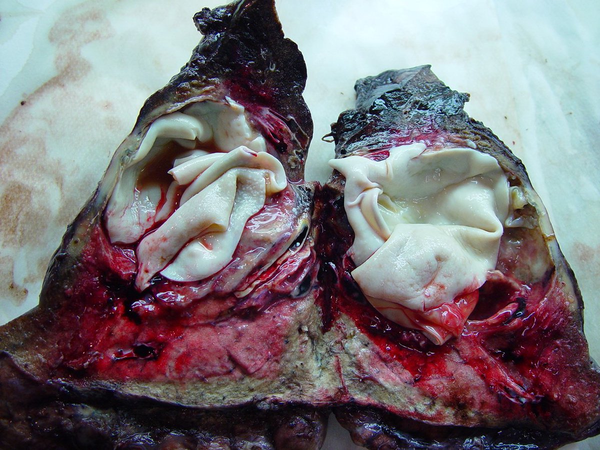 BellaMicheleang's tweet photo. lung: hydatidosis echinococcus cysts https://t.co/for2thj0Bf
