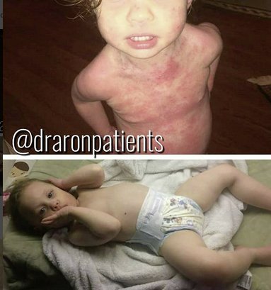 etsinmods's tweet photo. "She slept through the night last night" https://t.co/Rlc9xjra2V  #tswtoaronregimen #redskinsyndrome #topicalsteroidwithdrawal #topicalsteroidaddiction #eczema #eczemababy #lifeaftertsw #AronRegimen https://t.co/zN9nHzWhVf