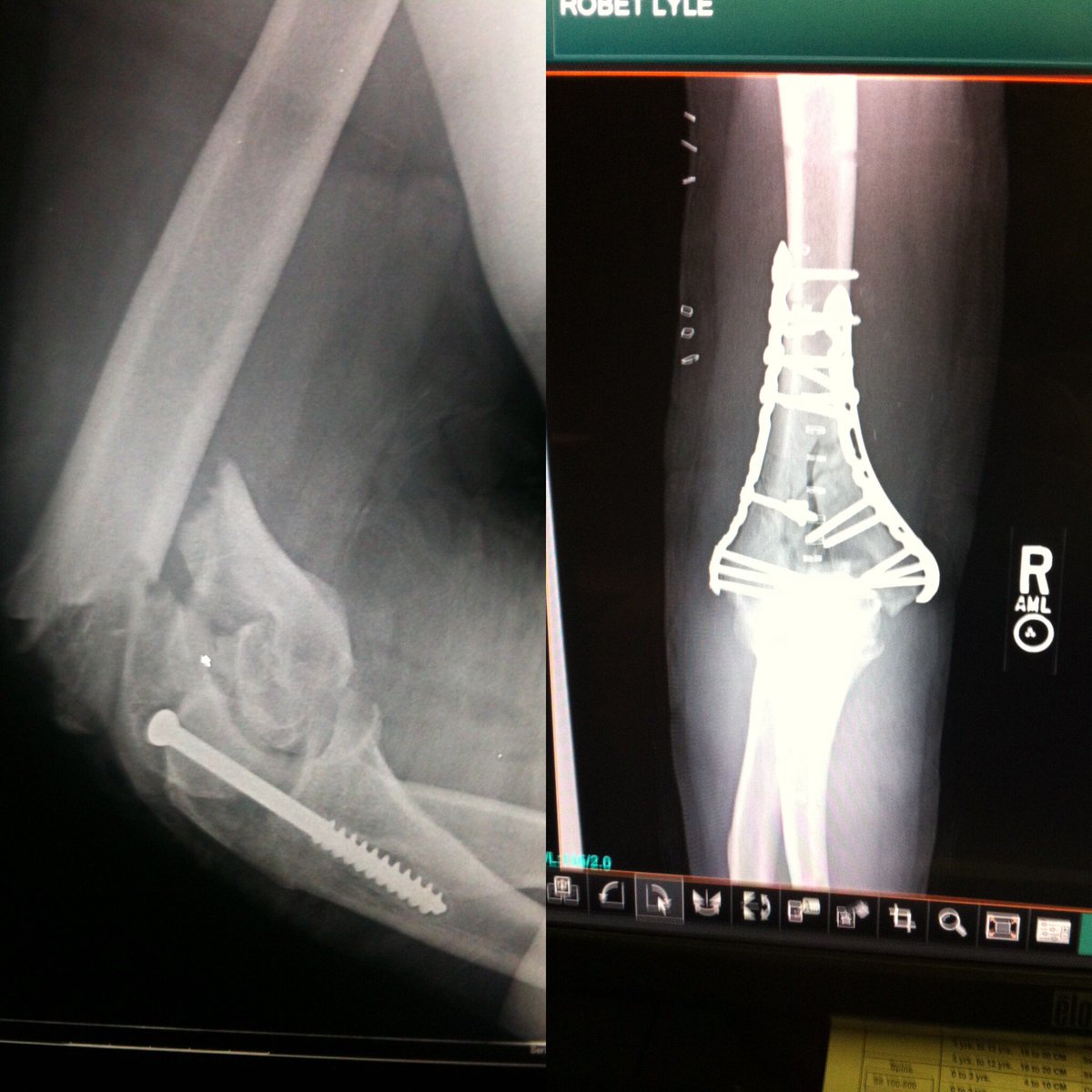 IronNEO's tweet photo. Five years ago today - tumbled off my bike #comeback18 #alaskaman #TeamIronCowboy @hopkinsanity @IronCowboyJames https://t.co/9enn947MUH