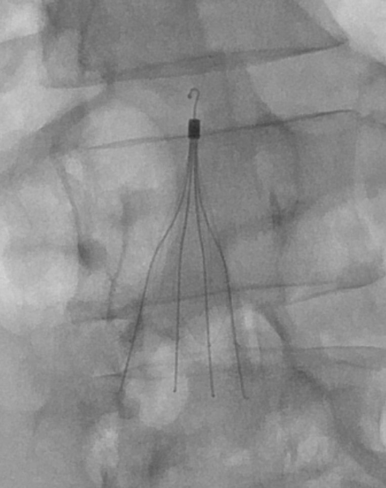 kmadass's tweet photo. Exciting when #Irad hopeful medstudent @KnightsOfNhi snares #filterOut on 1st try! #FutureOfIRisbright @TheRealDoctorOs @rkryu @kush_r_desai @robsheridanavir @SIRRFS @MountSinaiIR @IUIRad @AlbanyIR @SDhandMD @JonnyMoriarty @amdevane @IR_Doctor @Drshiloh @AlexCVIR @LessneVIR https://t.co/IqCLkM2SCP