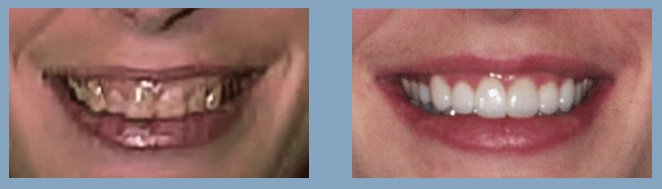 CraigSommerDDS's tweet photo. Hate your smile? Wish your teeth looked better?
Dr. Sommer can give you the smile of your dreams!
https://t.co/9WbyPusccf
#smile #newsmile #betterteeth #ColoradoSprings #dentist #cosmeticdentistry #cosmeticdentist https://t.co/g0mwMXbKZQ