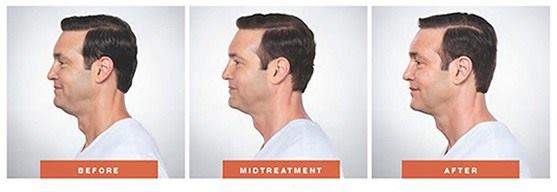 InfiniteSkinFL's tweet photo. KYBELLA® is the first FDA approved non-surgical injection for improving the appearance of moderate to severe submental fullness, commonly referred to as double chin.  #infiniteskinandlaser #skincare #skin #facials #skinfacials #botox https://t.co/9lW6ovYwj6