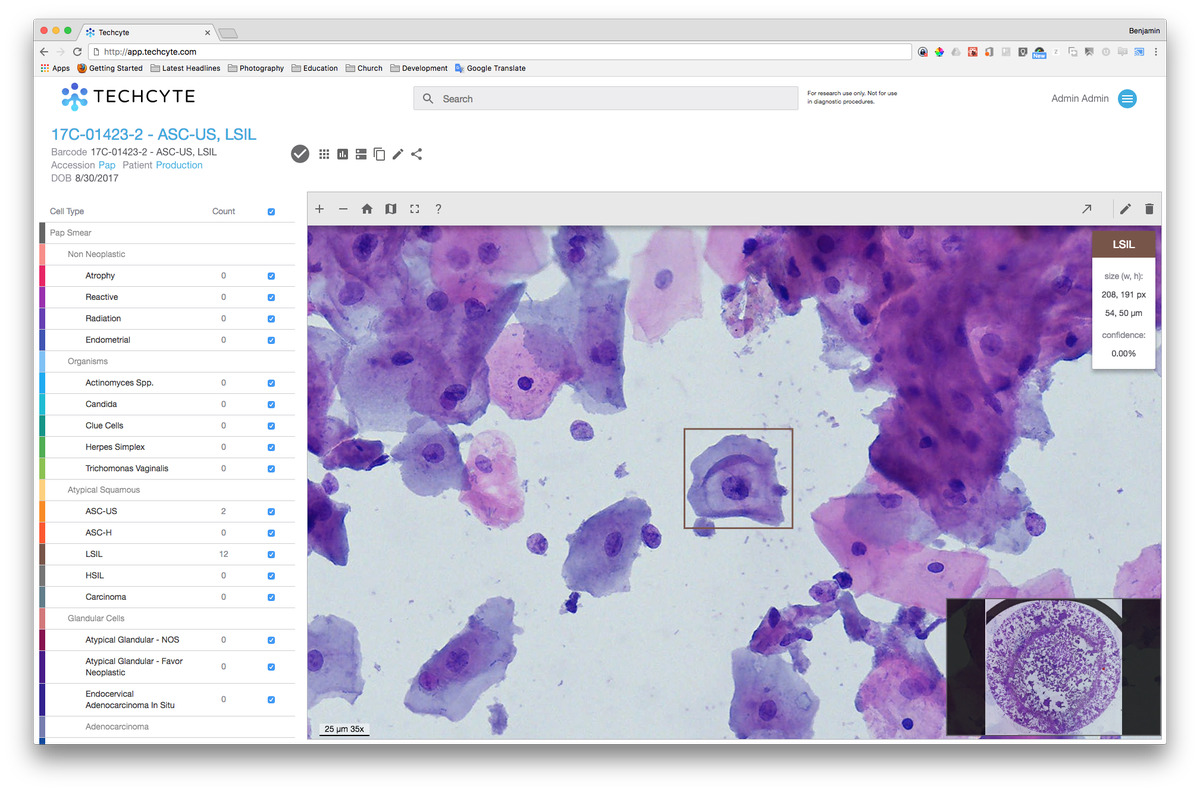 techcyte's tweet photo. Great study on how #digitalpathology is on par with traditional #microscopy by @smlungpathguy et al.: https://t.co/EXshbfmrjl
In addition, digital pathology provides easy collaboration, archiving, and AI assisted diagnostics. Check out #Techcyte. #cellularpathology #cytology https://t.co/PDWean12z7
