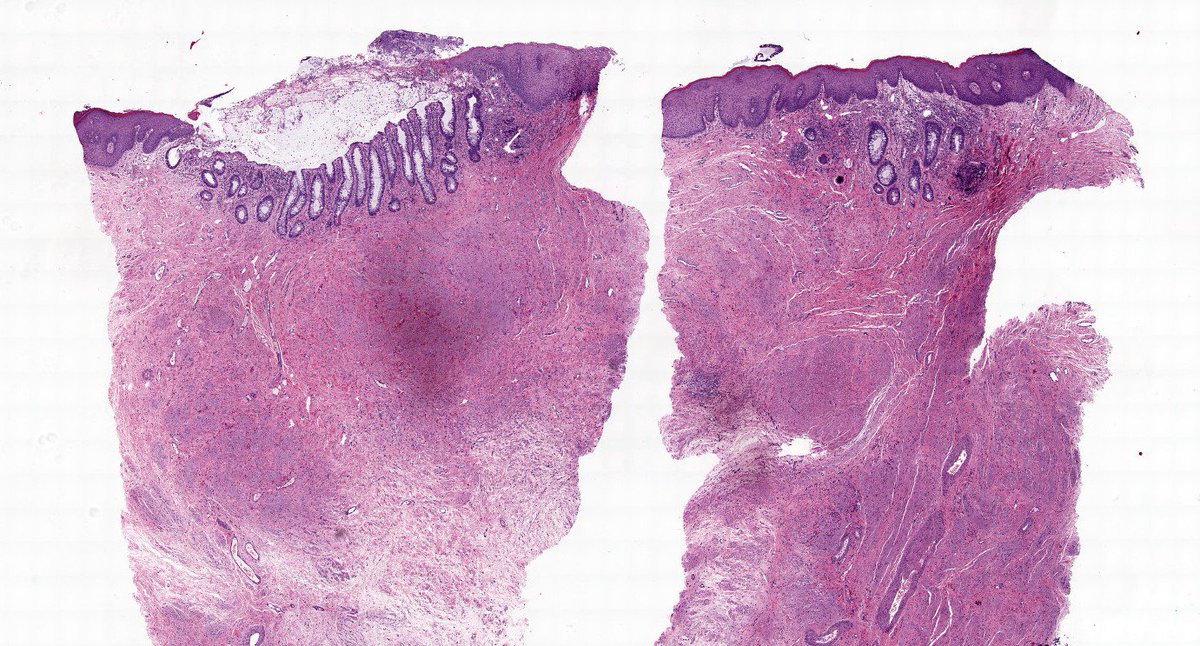 sortizreina's tweet photo. Vulvar cutaneous intestinal metaplasia / ectopic intestinal mucosa, in patient with Crohn's disease.
Pseudostratied columnar glandular epithelium, intestinal type, with goblet cells inside the skin.
#dermopath #pathology https://t.co/pZkyDpy21i