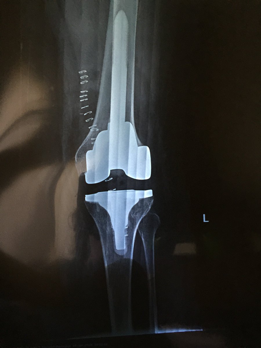 ElaZemp2's tweet photo. @KneeReplacement @neiltheknee @mattbarbermd @TheKneePainGuru, survived my revision, glad it’s all done, now just to get on with the healing process again... pain is more then last time, but it feels way more stable, I just need to keep on top of meds. https://t.co/5JpcHvxiUw
