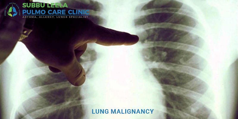 subbuleelapulmo's tweet photo. The treatments for early and locally advanced lung cancer.
Contact +91-7845501546
#Lungmailgnancy #lungdisease #lungs #pulmocare #Disease #asthma #healthcare #health #pulmocare #clinic #Interstitiallungdisease
https://t.co/nrRN0oQbct https://t.co/ASfMi40aPA