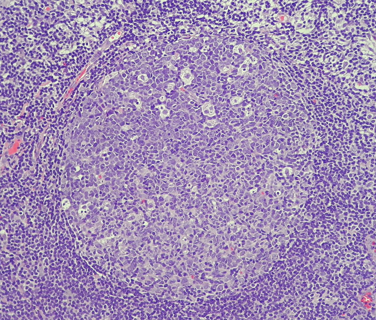 crazylymphocite's tweet photo. follicular hyperplasia lymph node
#1= germinal center overview Polarity in 2 distinct light &amp; dark zones
#2= centroblast (large non-cleaved B cell)-left/up &amp; centrocytes (small cleaved B cell)-righ/down
#3= tingible body macrophages
#4= ki67
#hemepath @Histopatolomon @EAljufairi https://t.co/CqHcxt6eKn